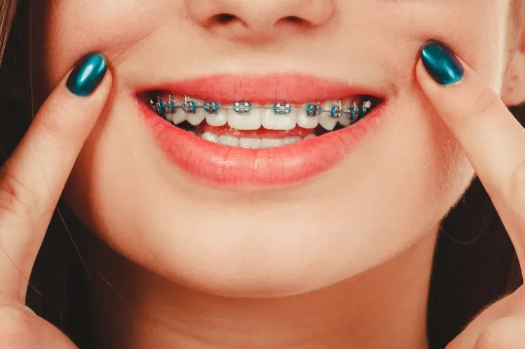 A person showing their colored braces