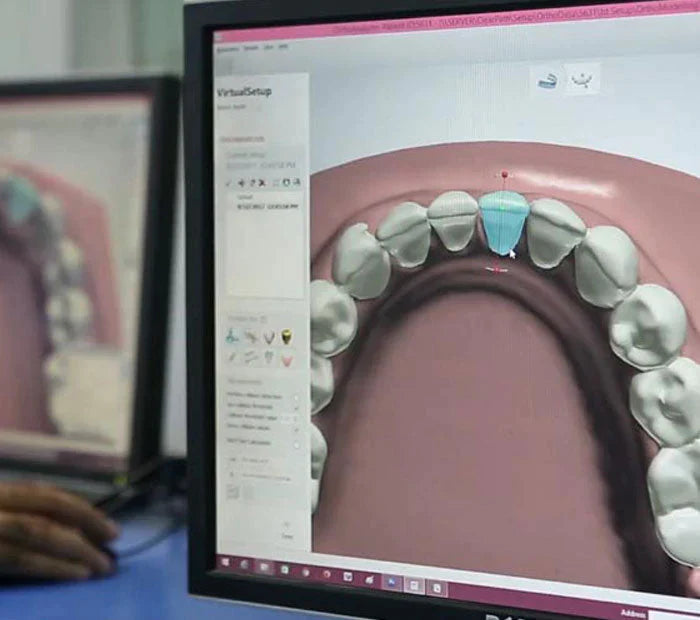 SmilePath Flex Easy