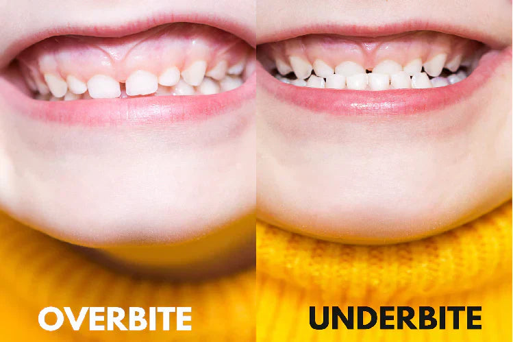 A side-by-side comparison of an underbite and overbite, showing the misalignment of upper and lower teeth