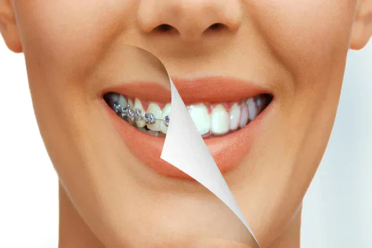 Gambar dekat gigi wanita dengan penjajar di satu sisi dan pendakap di sebelah yang lain.