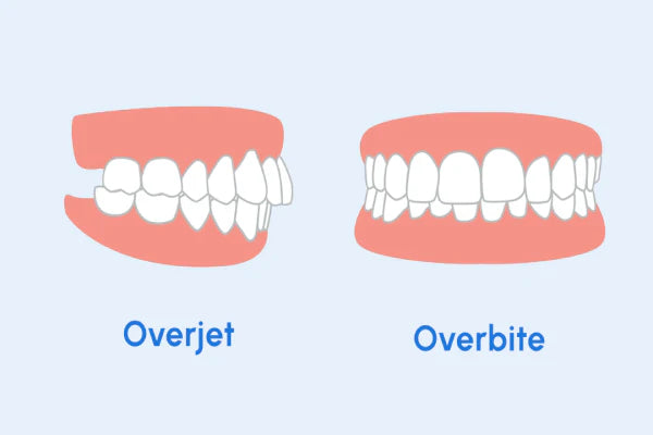 Imej yang menunjukkan Overbite vs Overjet.