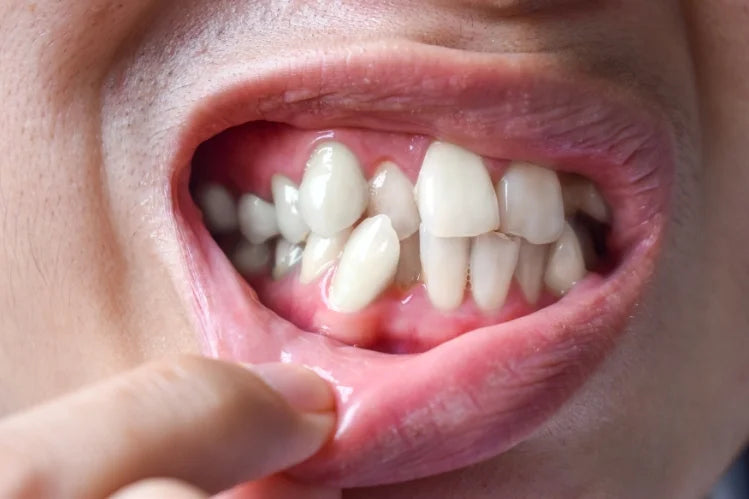 An image of a boy suffering from crooked teeth