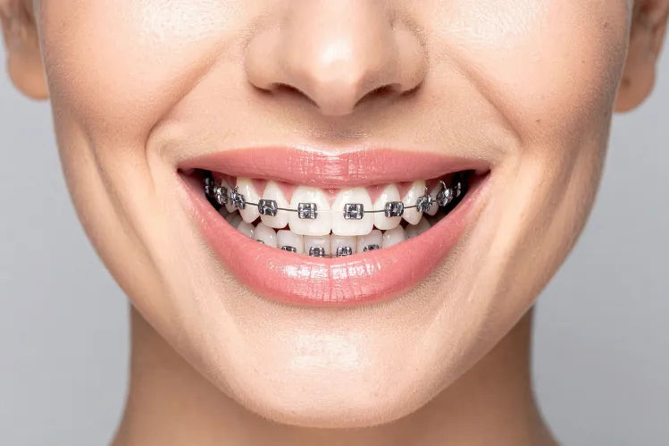 Seorang model dengan senyuman close-up braces.