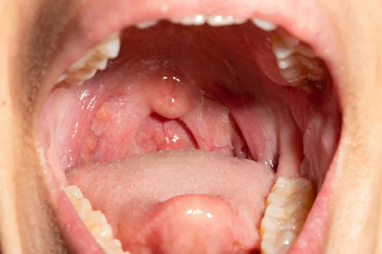 Tutup mulut terbuka dengan gigi belakang