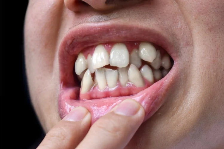 Teeth Shifting with Age: Uncovering Causes, Risks, and Solutions