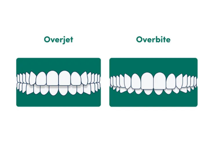 Ilustrasi overjet berbanding overbite