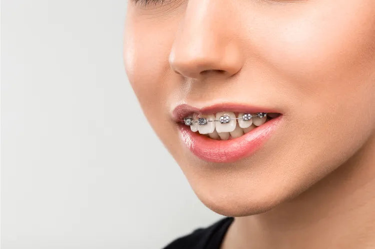 Gambar jarak dekat senyuman overbite dengan pendakap gigi