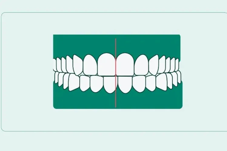 Boleh Kosongkan Aligners Membetulkan Kepincangan Garis Tengah