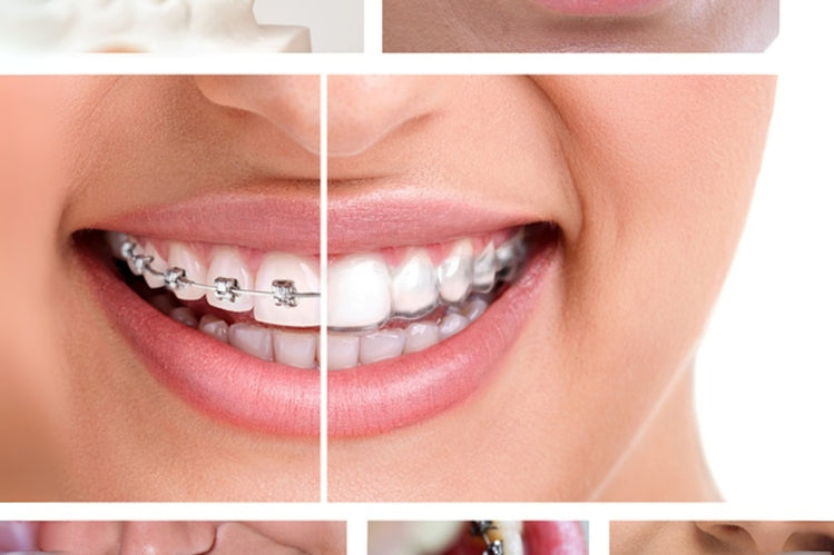 Half-and-half image of a women wearing both braces and clear aligners
