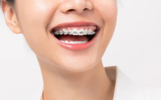 Seorang gadis tersenyum dengan pendakap gigi.